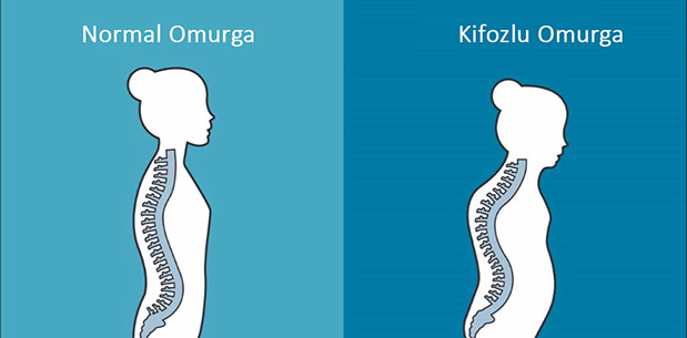 Kifoz Nedir?